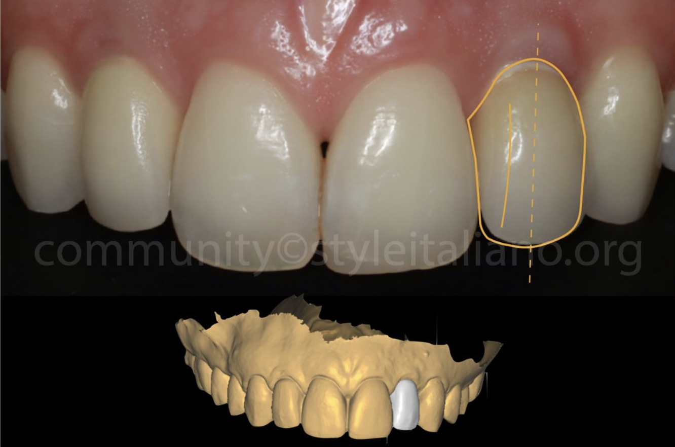 Điều Trị Lại Một Mão Răng Trên Implant: Tối ưu hoá kết quả bằng phần mềm OptiShade